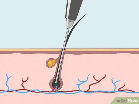 Image titled Remove Male Pubic Hair Without Shaving Step 20