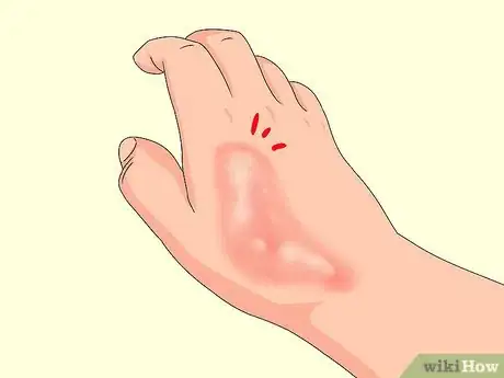 Image titled Determine if a Burn Is Infected Step 1