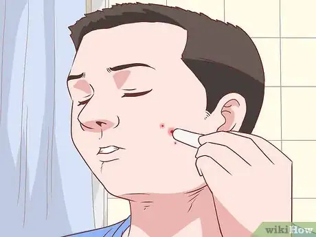 Image titled Stop a Zit from Bleeding Step 4