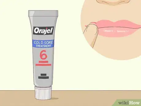 Image titled Get Rid of a Cold Sore Step 1