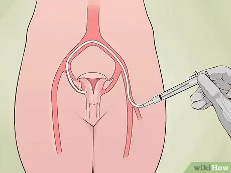 Image titled Decide if You Need a Hysterectomy Step 22