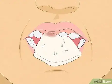 Image titled Pull a Loose Tooth at Home Step 10