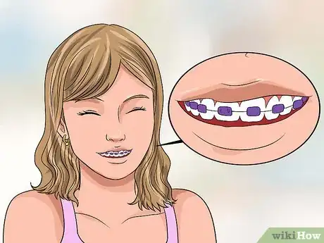 Image titled Choose the Color of Your Braces Step 6