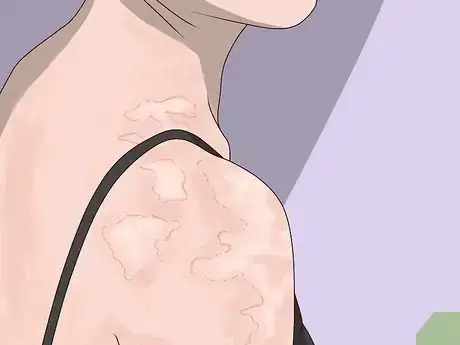 Image titled Know Skin Types Step 13