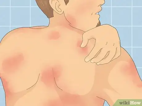 Image titled Heal Armpit Rash Step 3