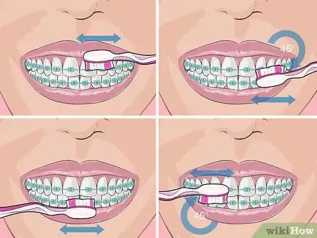 Image titled Deal with Braces Step 1