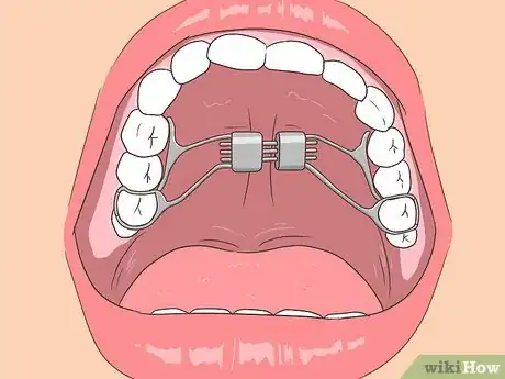 Image titled Fix an Underbite Step 3