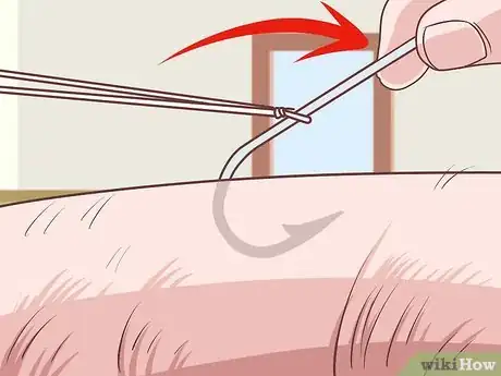 Image titled Remove a Fishhook from Skin Step 10