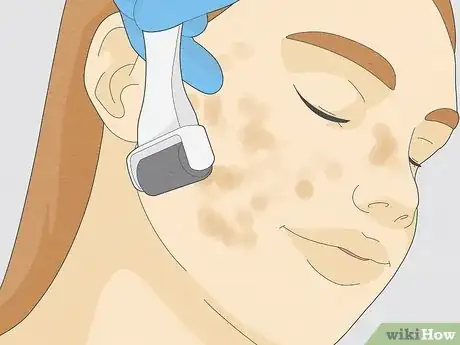 Image titled Get Rid of Cystic Acne Scars Step 15
