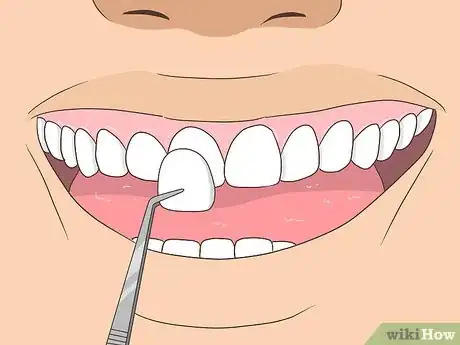 Image titled Fix an Underbite Step 8