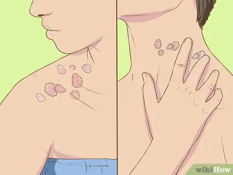 Image titled Recognize Shingles Symptoms (Herpes Zoster Symptoms) Step 2