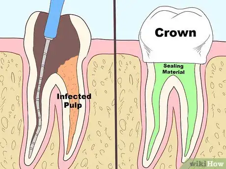 Image titled Keep a Cavity from Getting Worse Step 12