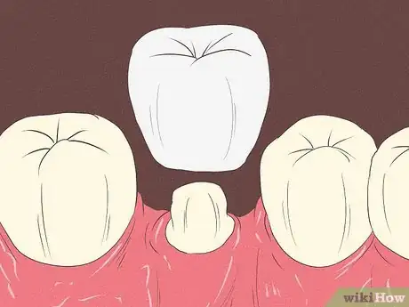 Image titled Get Rid of Tooth Pain Step 16