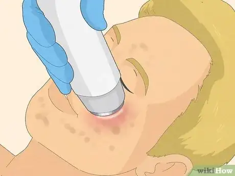 Image titled Get Rid of Cystic Acne Scars Step 13