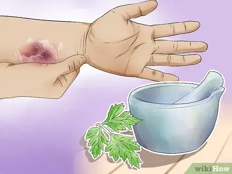 Image titled Use Herbs for Sprains and Bruises Step 6