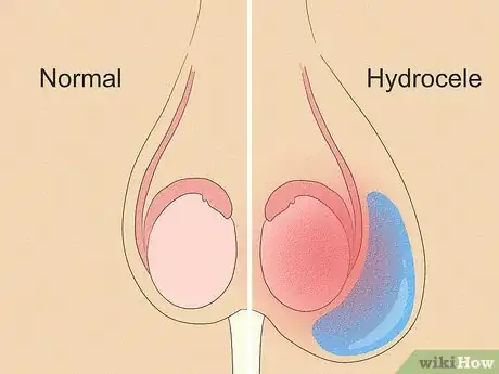 Image titled Cure a Hydrocele Step 1