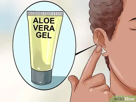 Image titled Get Rid of Pimples Inside the Ear Step 13