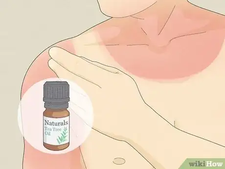 Image titled Use Aloe Vera to Treat Burns Step 10