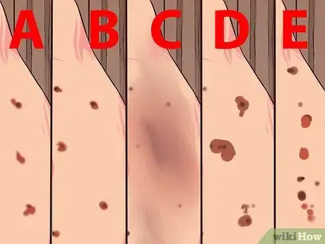 Image titled Perform Melanoma Skin Checks Step 9