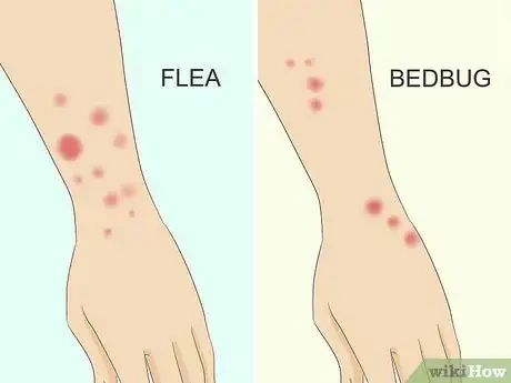 Image titled Treat Bed Bug Bites Step 1