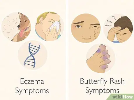 Image titled Tell Eczema from Butterfly Rash Step 3