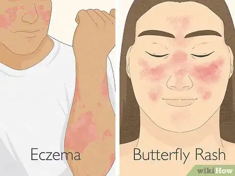 Image titled Tell Eczema from Butterfly Rash Step 1