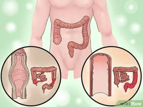 Image titled Distinguish Ulcerative Colitis from Similar Conditions Step 7