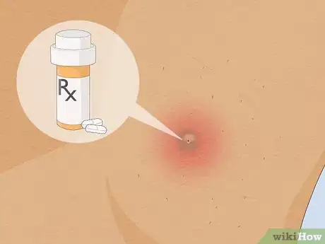 Image titled Remove an Ingrown Hair Under the Skin Step 12