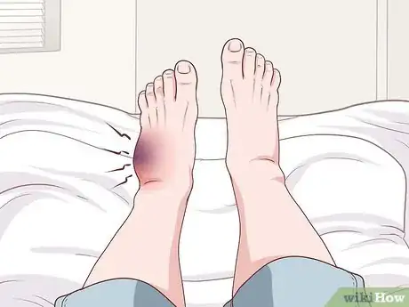 Image titled Recover From Foot Surgery Step 13