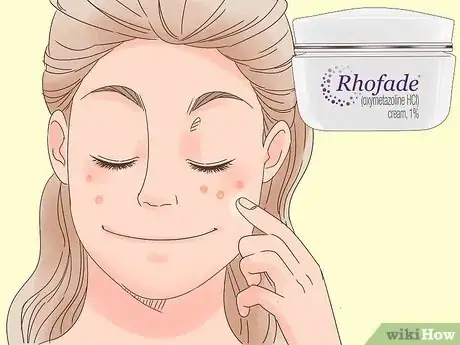 Image titled Remove the Redness of a Pimple Step 11