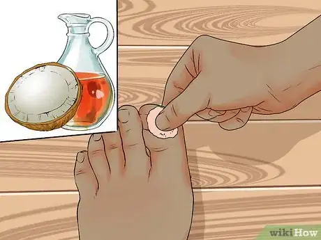 Image titled Avoid Ingrown Toenails Step 10