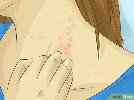 Image titled Stop Scratching Irritated Skin Step 17