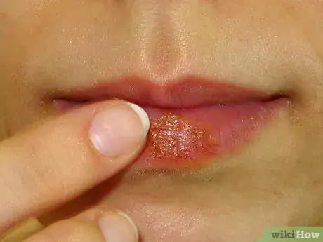 Image titled Make Your Own Lip Plumper at Home Step 15