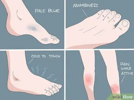 Image titled Treat Itchy Feet Caused by Diabetes Step 15