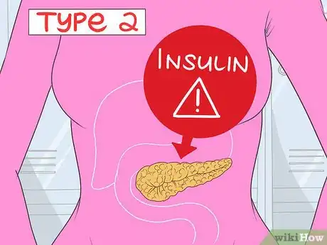 Image titled Understand the Difference Between Type 1 and Type 2 Diabetes Step 3