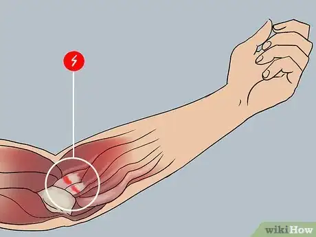 Image titled Cure Forearm Pain Step 4