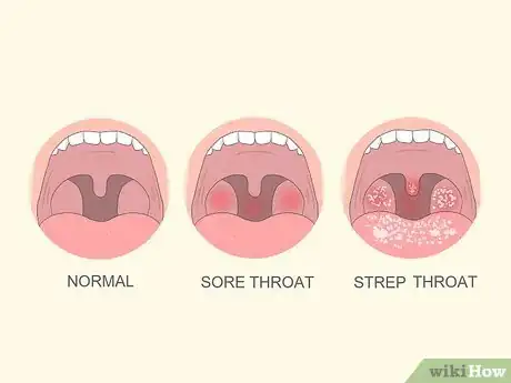 Image titled Tell if You Have Strep Throat Step 1