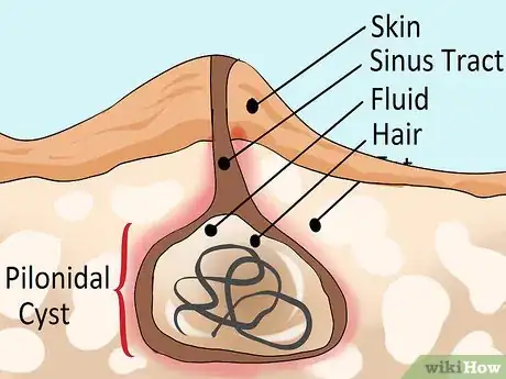 Image titled Treat a Pilonidal Cyst Step 10