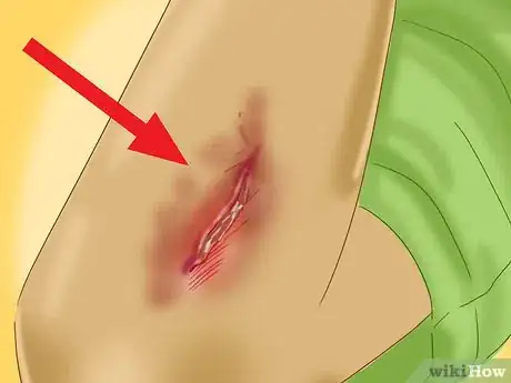 Image titled Treat a Skin Flap or Abrasion During First Aid Step 9