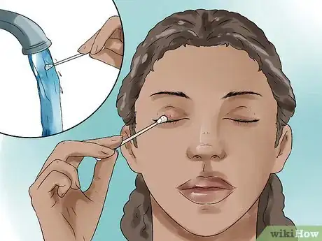 Image titled Get Rid of a Stye Step 1