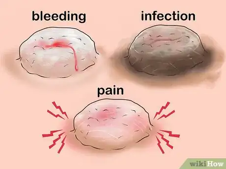 Image titled Get a Wart Surgically Removed Step 3