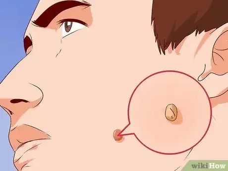 Image titled Get Rid of Ingrown Hair Scars Step 8