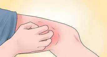 Tell the Difference Between Eczema and Psoriasis