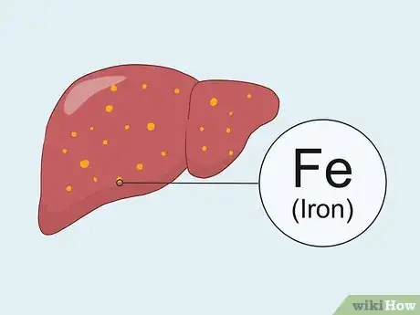 Image titled Treat Liver Fibrosis Step 7