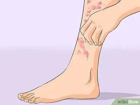 Image titled Treat Cellulitis Step 2