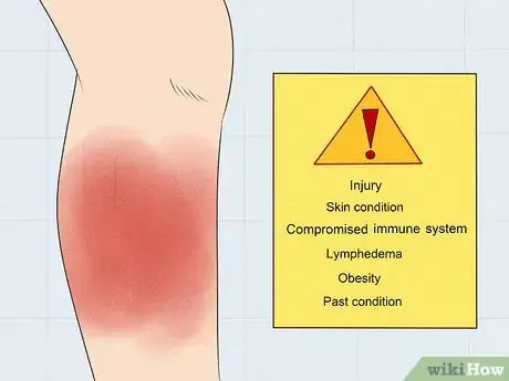 Image titled Treat Cellulitis Step 1