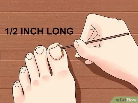 Image titled Heal an Ingrown Toenail Step 4