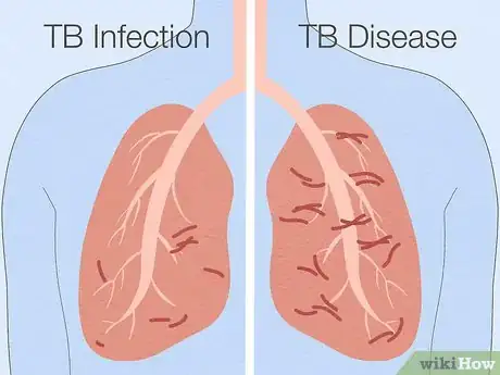 Image titled Properly Place a TB Skin Test Step 2