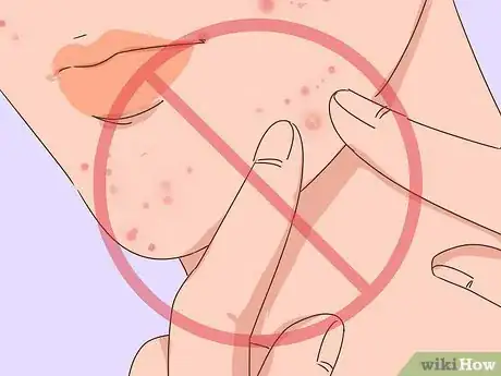 Image titled Get Rid of Acne Fast Step 15