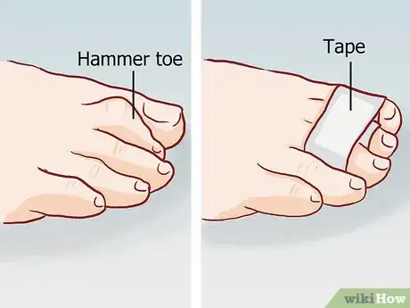 Image titled Straighten Toes Step 11